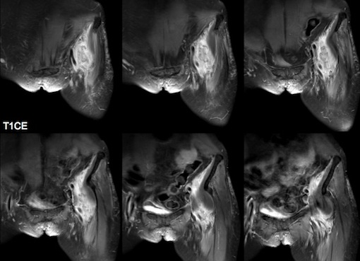 Figure 5 for case Neuritis Ossificans